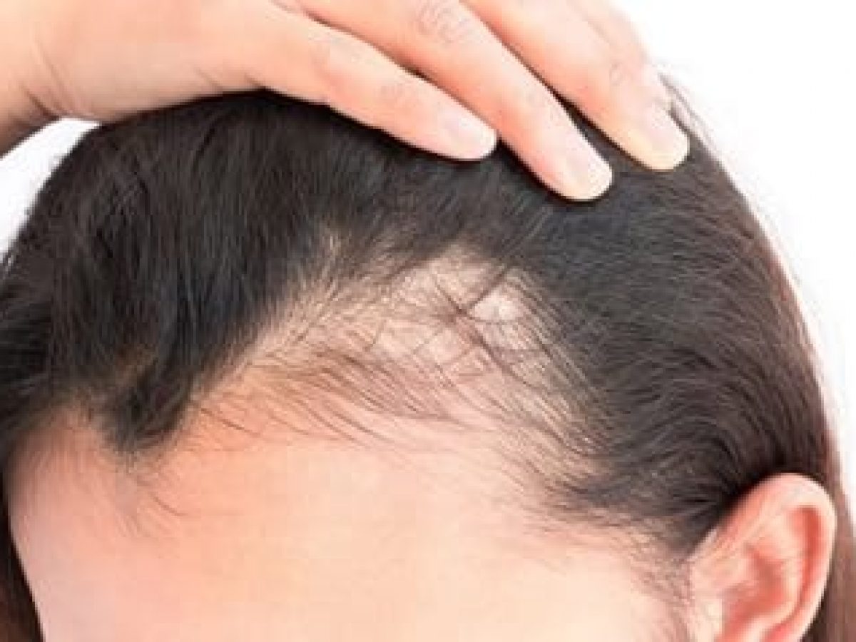 el estrés acelerar la pérdida cabello | Kmax España